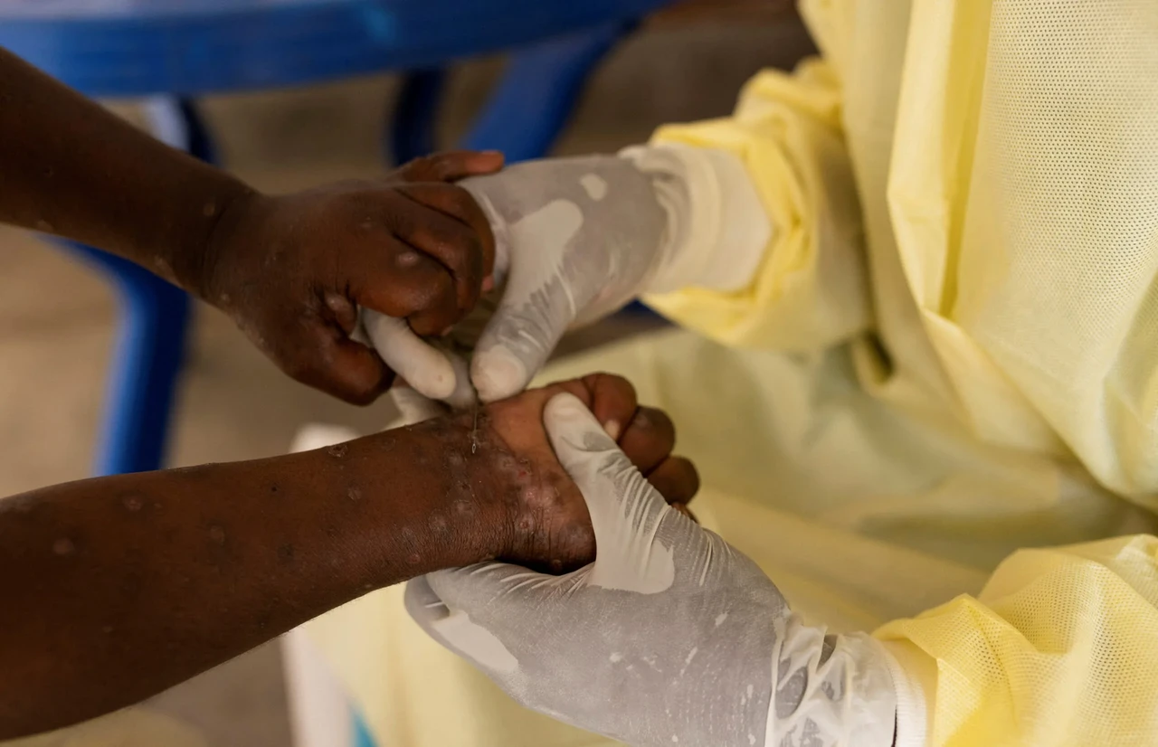 Mpox outbreak declared public health emergency in Africa