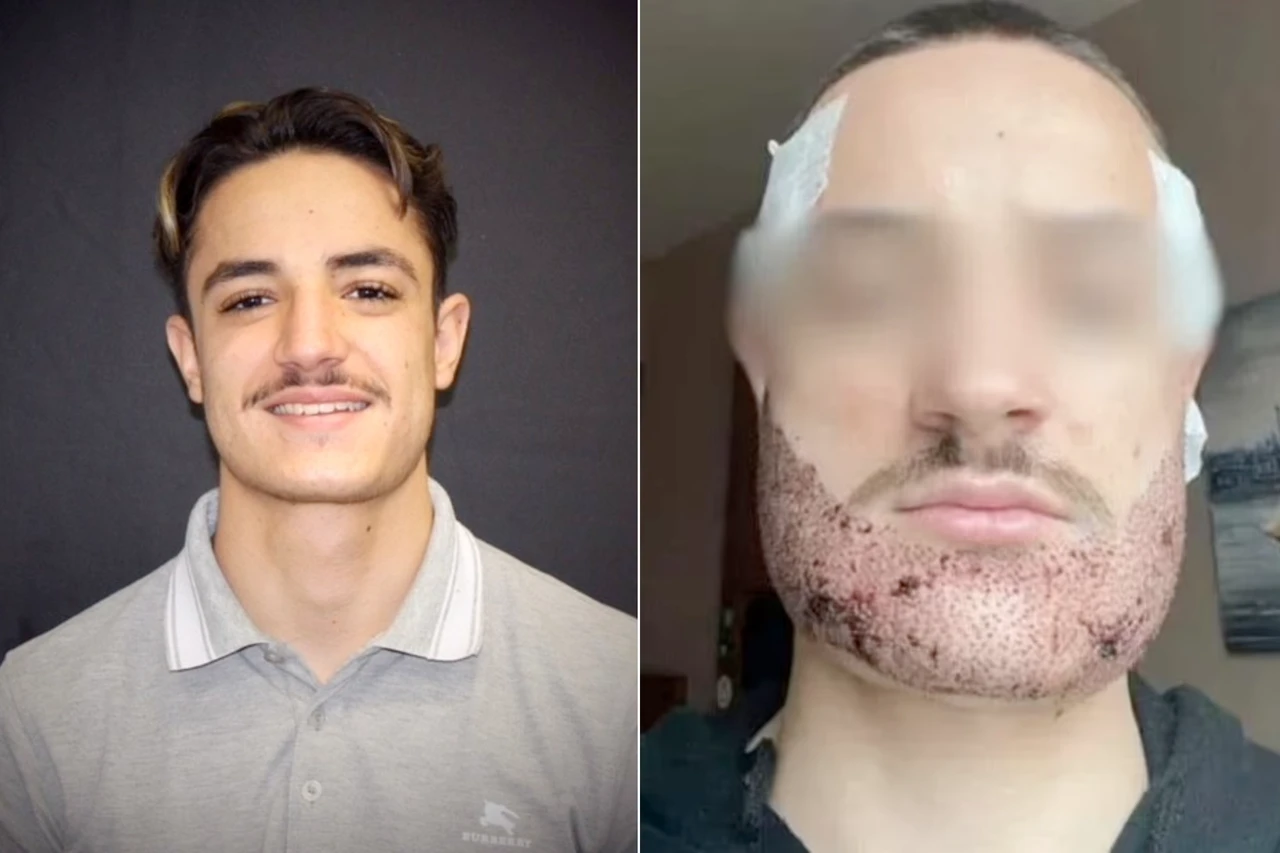 botched beard transplant in Türkiye