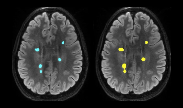 Turkish AI system achieves 95% accuracy in multiple sclerosis diagnosis