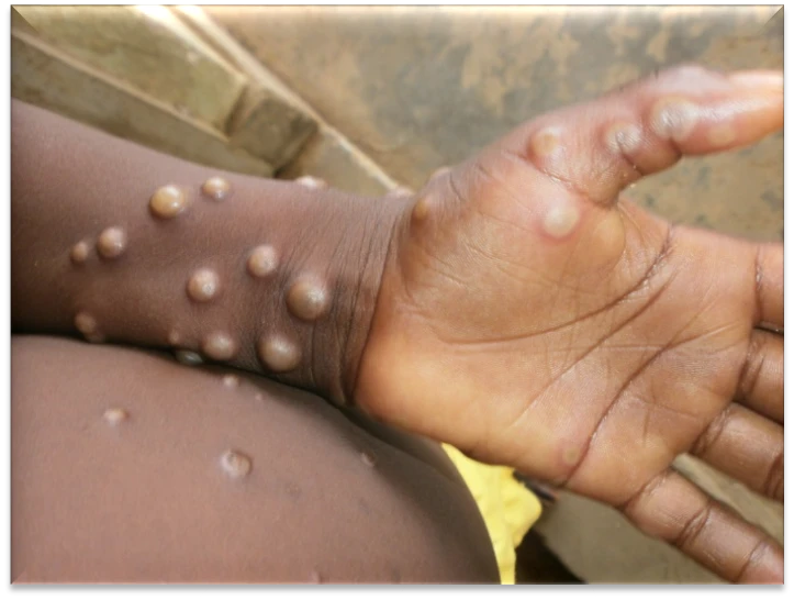 Mpox cases in Pakistan climb to 6