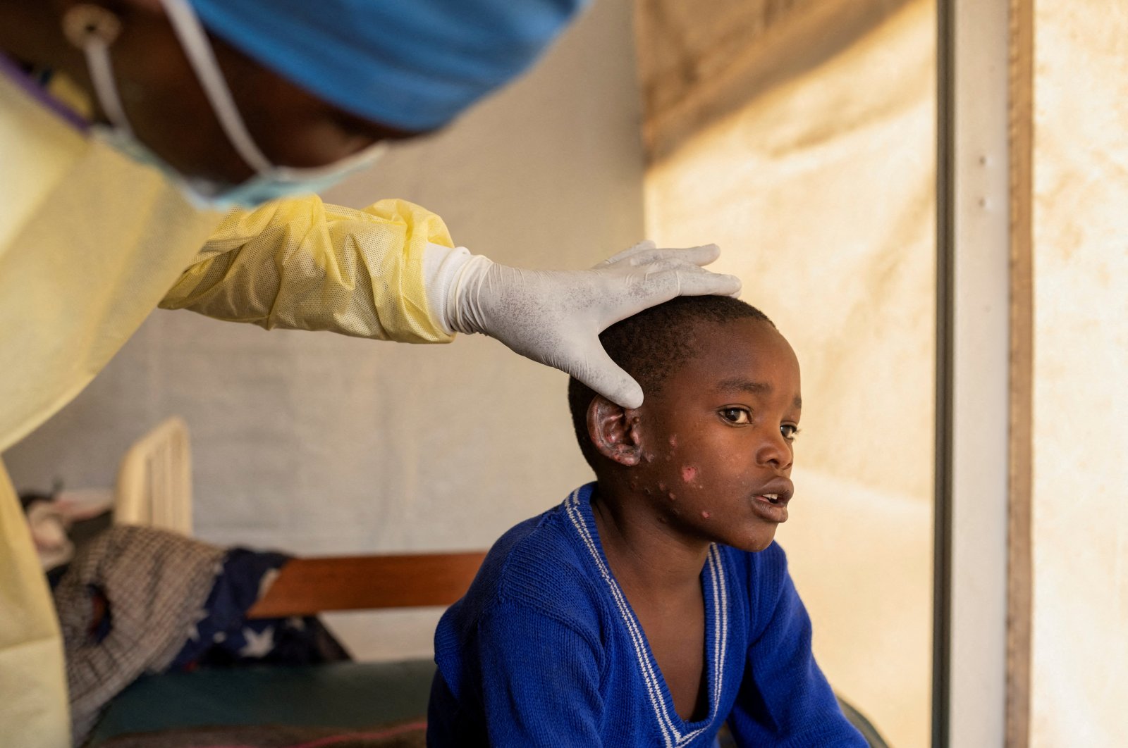 Mpox confirmed in Sweden: First clade 1b variant outside Africa