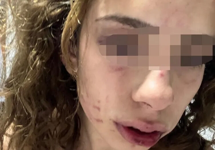 S.A.’s face shows extensive bruising and injuries from the assault, Konya