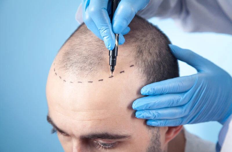 Close-up of head before hair transplant with a marked hairline as a medical professional wearing blue gloves prepares for a hair transplant procedure in Türkiye.