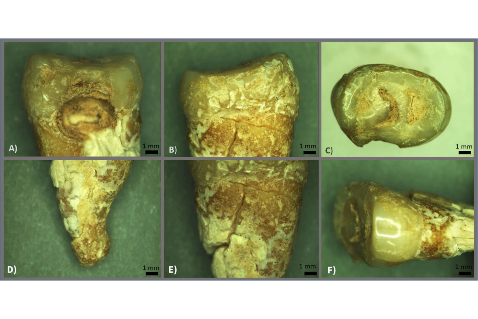 A set of six close-up microscopic images of an ancient upper premolar tooth from the burial. The images display visible decay, structural details, and sections of the tooth under magnification, with a 1 mm scale reference.